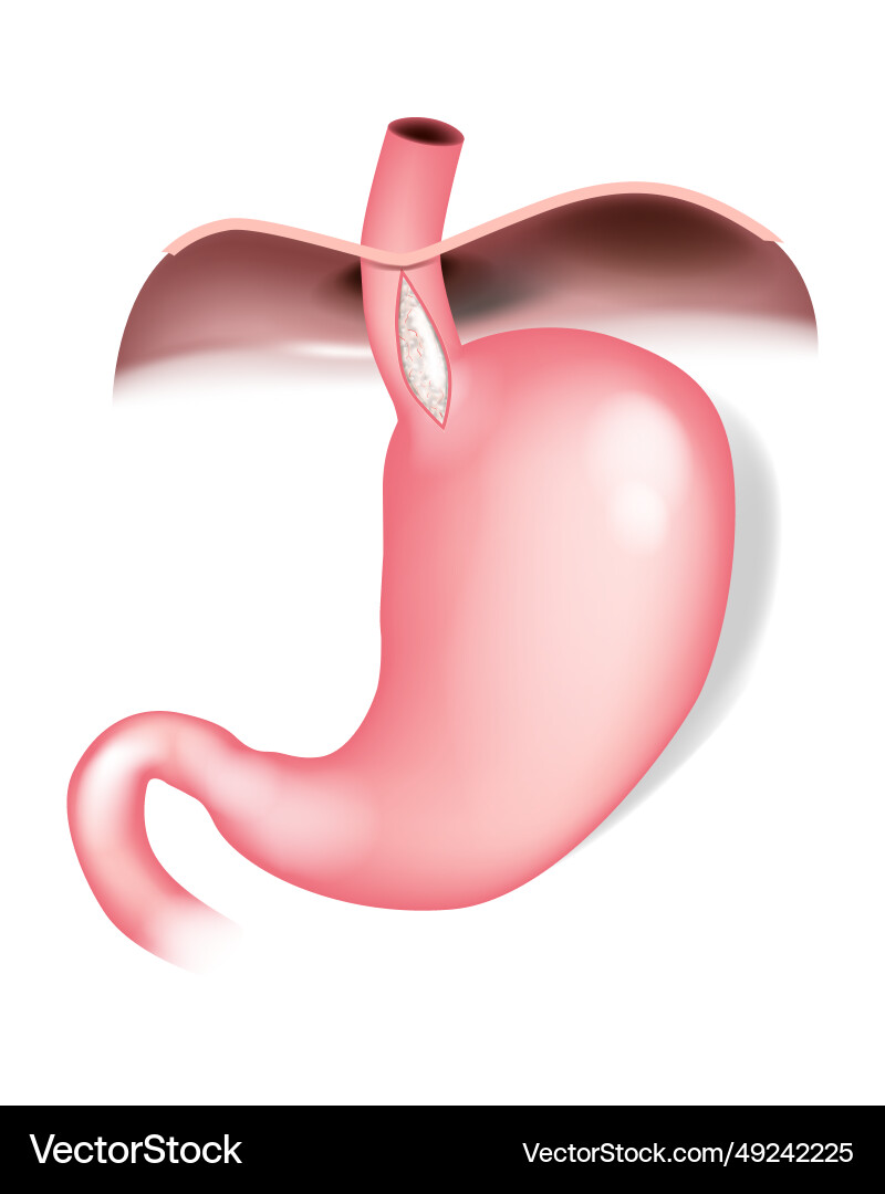 Laparoscopic heller myotomy procedure Laparoscopic heller myotomy procedure vector image