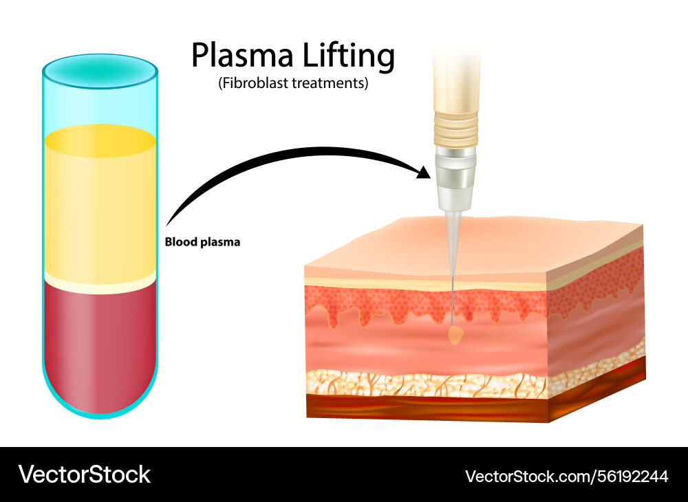 Plasmaheben oder Fibroblastenbehandlungen Blut Plasmaheben oder Fibroblastenbehandlungen Blut vektorbild