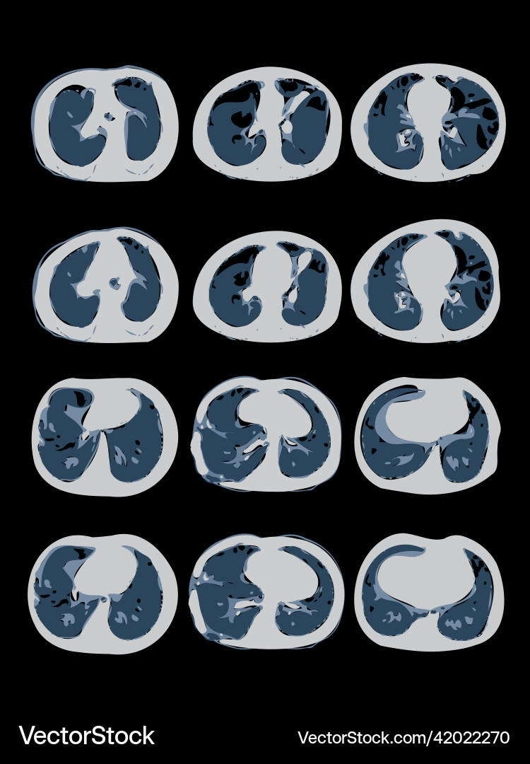 Covid-19 computed tomography of the lungs ct scan Vector Image