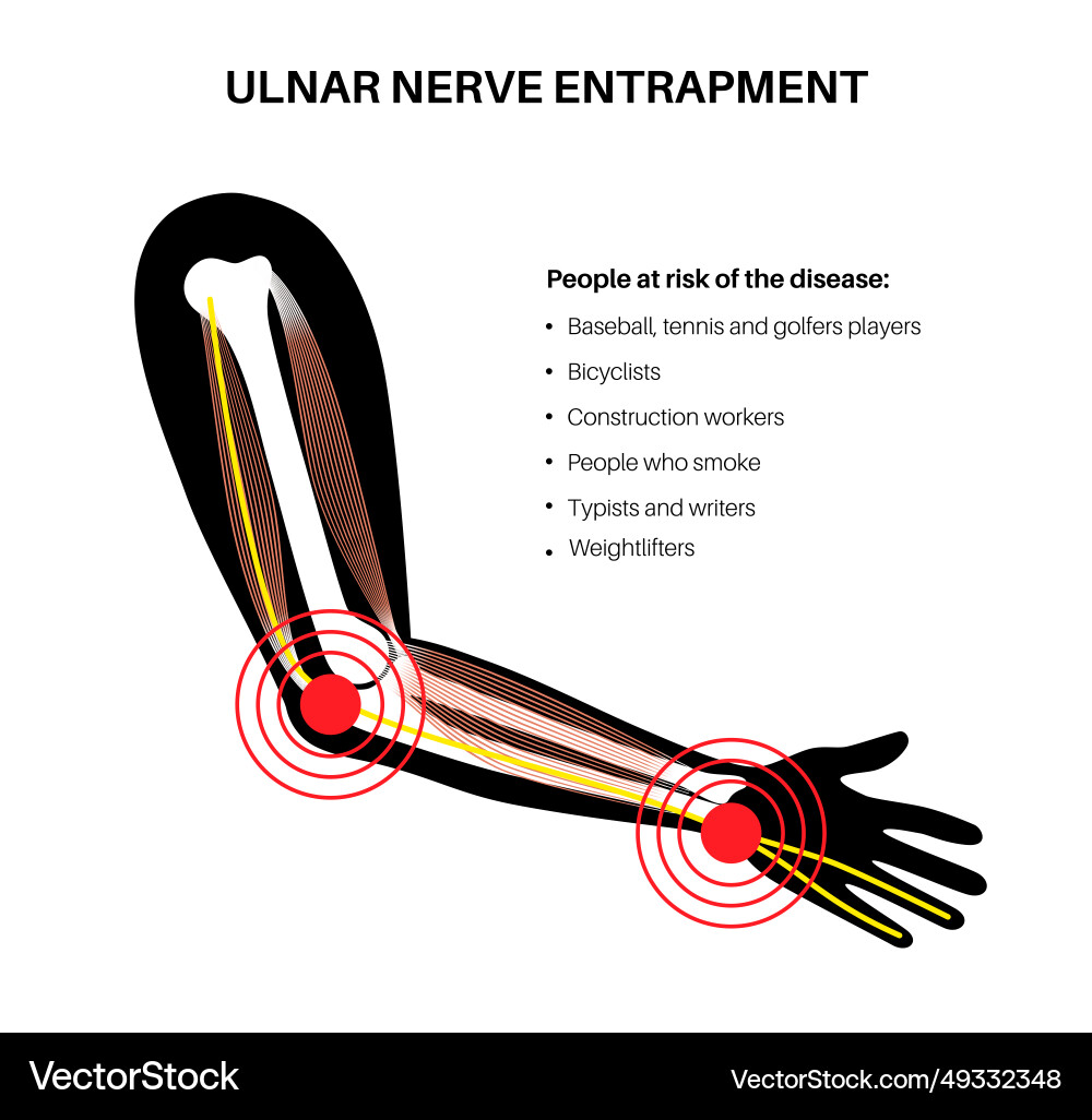Ulnar nerve entrapment Ulnar nerve entrapment vector image