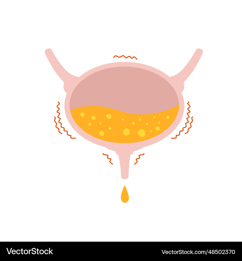 Overactive bladder urinal overflow vector image