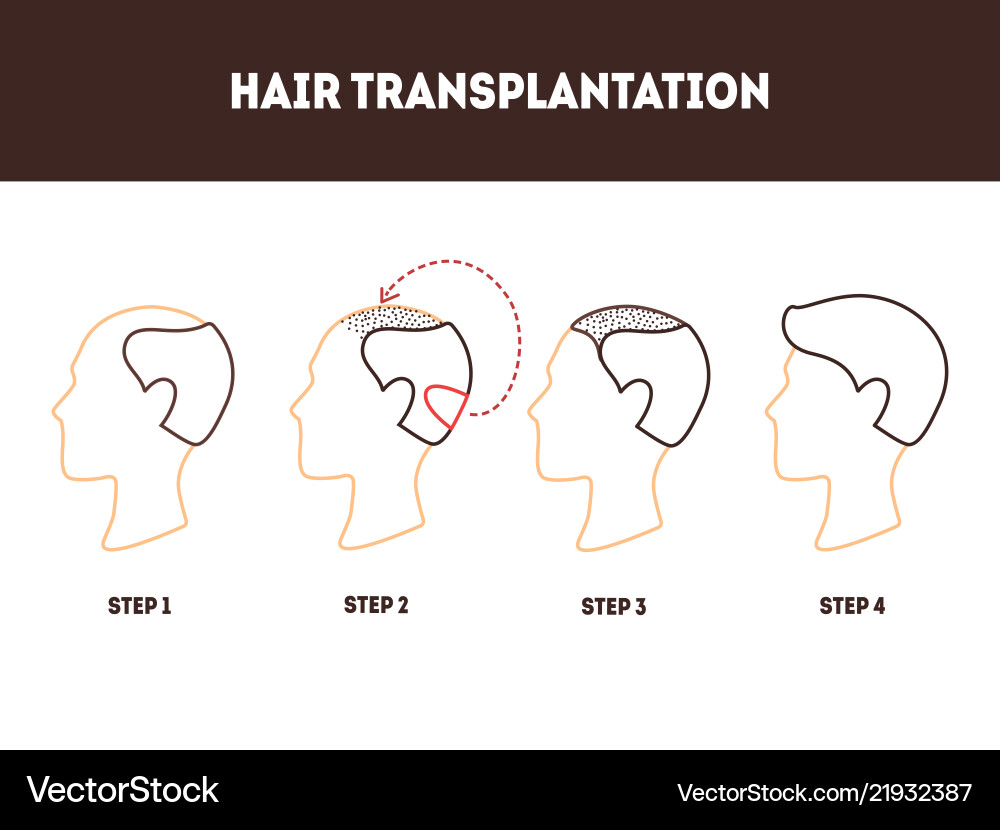 Dünne Linie Haartransplantation Chirurgie Karte Poster Dünne Linie Haartransplantation Chirurgie Karte Poster vektorbild