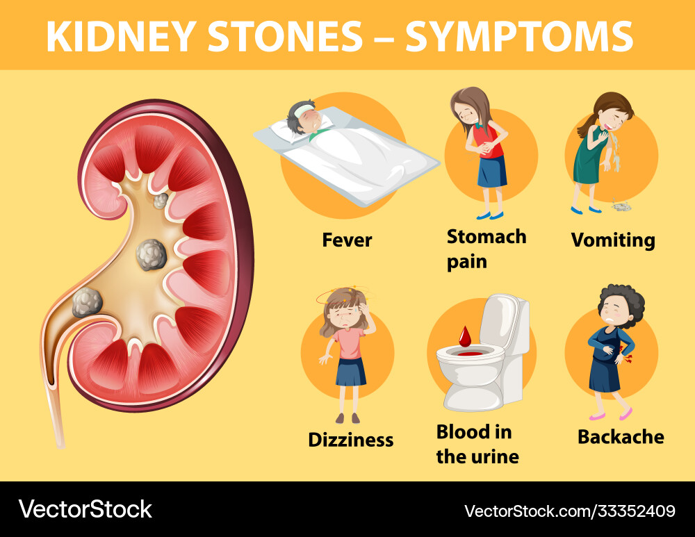 Kidney stones symptoms cartoon style infographic Kidney stones symptoms cartoon style infographic vector image