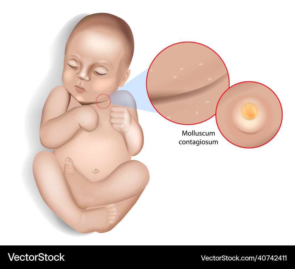 Molluscum contagiosum Virus Infektion Wasser Warzen Molluscum contagiosum Virus Infektion Wasser Warzen vektorbild