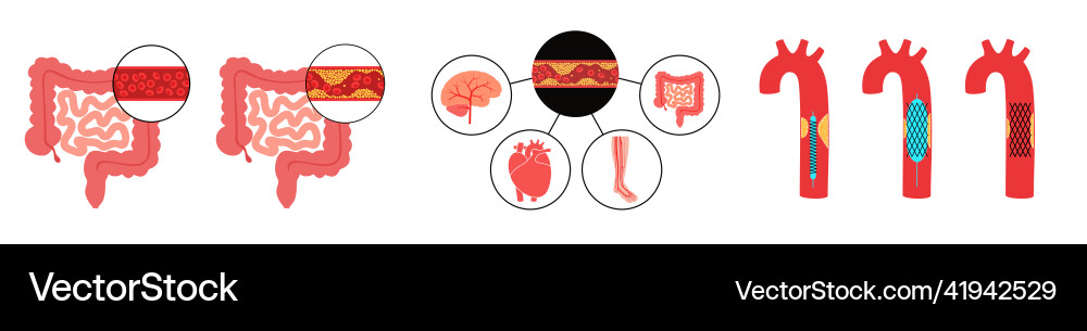 Types of ishemia Types of ishemia vector image