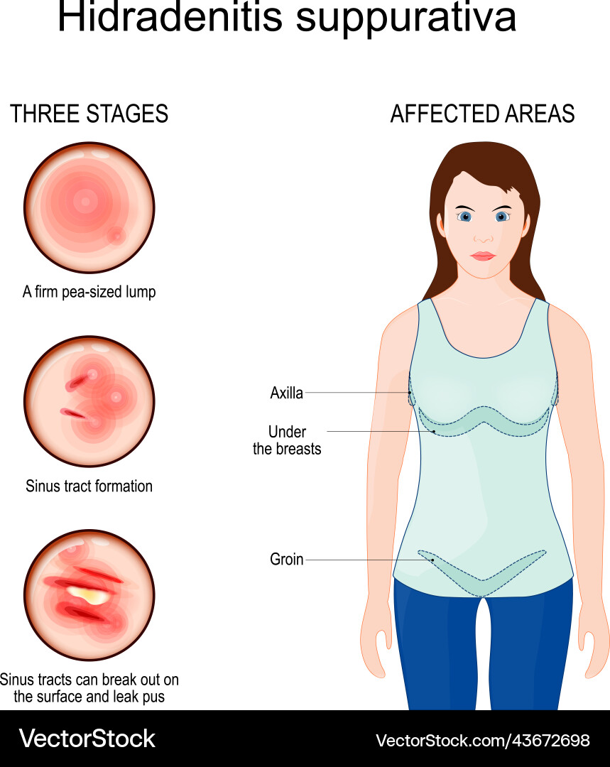 Hidradenitis suppurativa betroffen Bereiche der Akne Hidradenitis suppurativa betroffen Bereiche der Akne vektorbild
