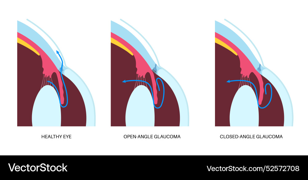 Glaucoma eye disease Royalty Free Vector Image