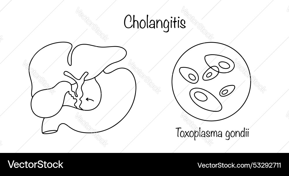 Cholangitis Cholangitis vector image