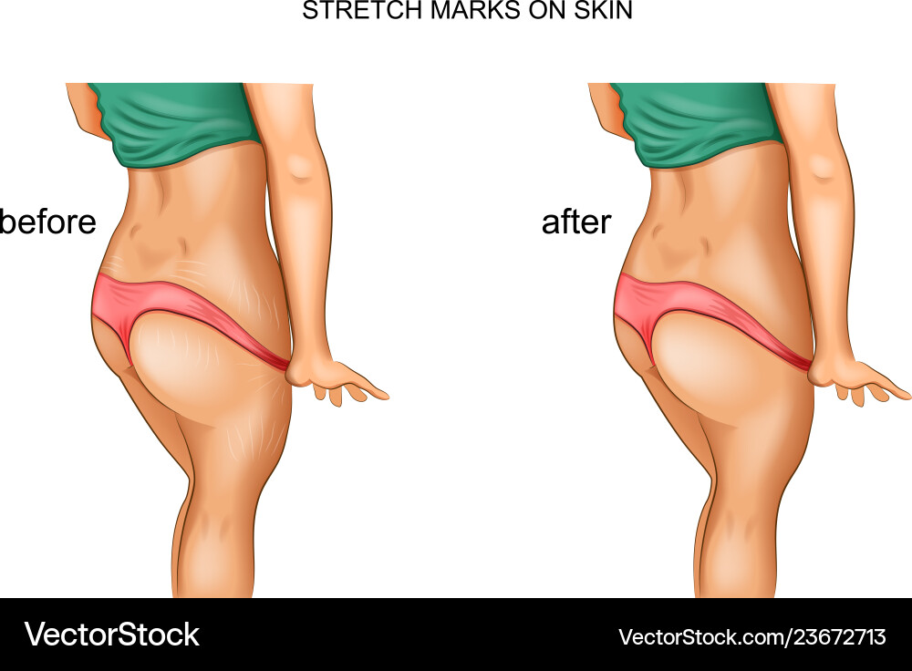 Stretch marks before and after Stretch marks before and after vector image