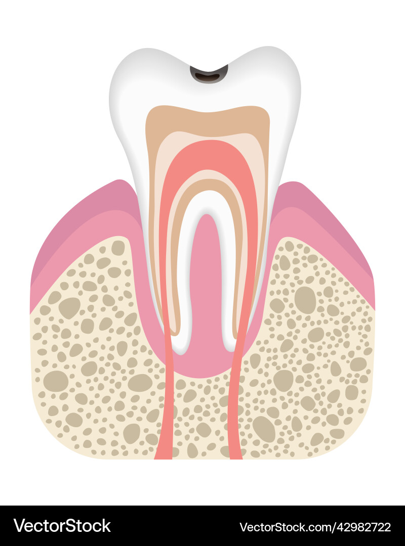 Stage of caries development tooth structure Stage of caries development tooth structure vector image