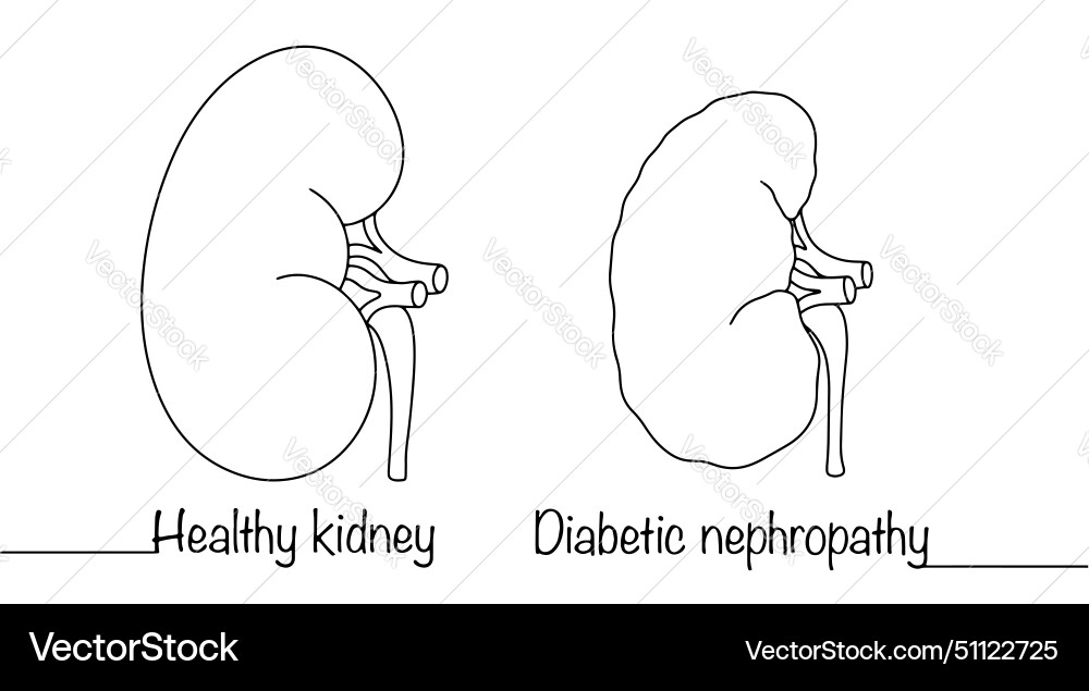 Diabetic nephropathy vector image