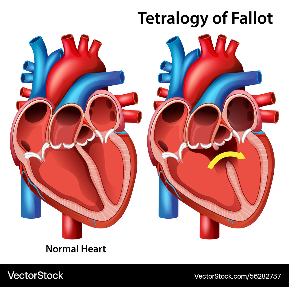 Comparing a normal heart with tetralogy of fallot Vector Image