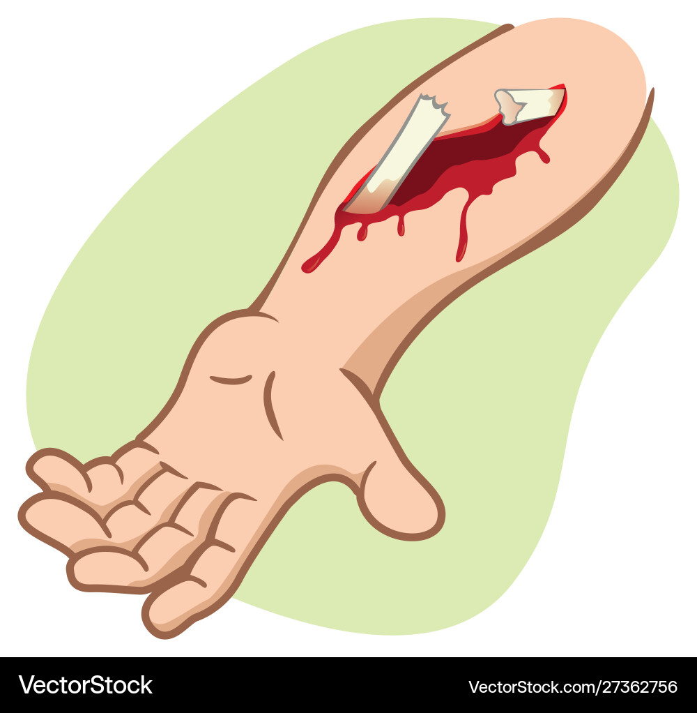 Arm mit Knochenbruch Arm mit Knochenbruch vektorbild