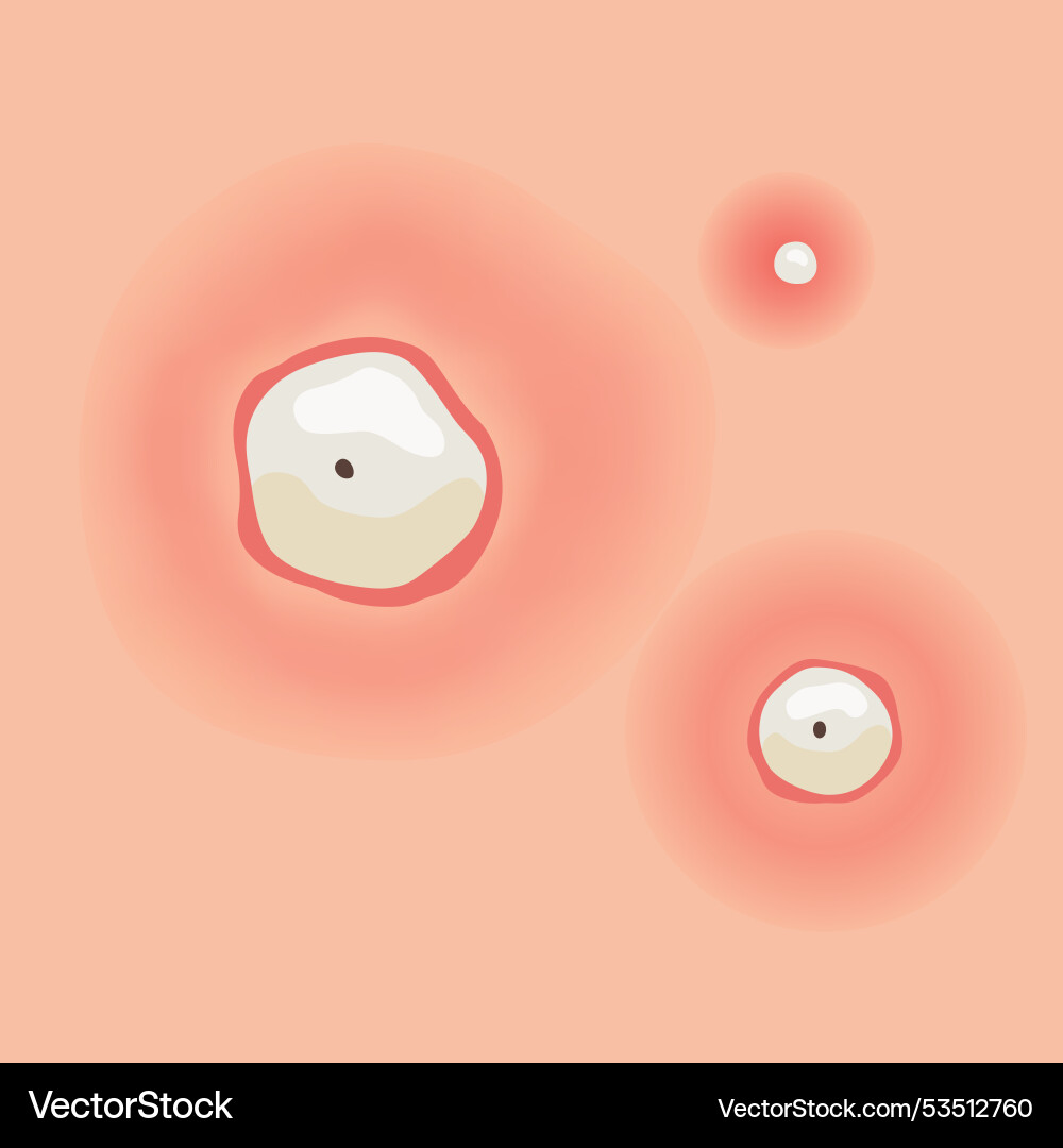 Understanding type of acne a comprehensive visual Vector Image