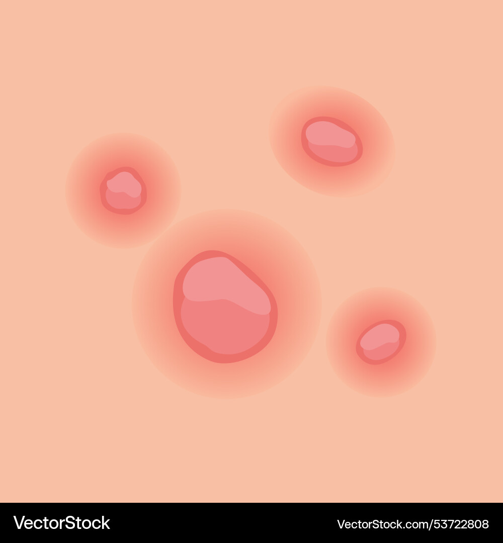 Understanding type of acne a comprehensive visual Understanding type of acne a comprehensive visual Vector Image