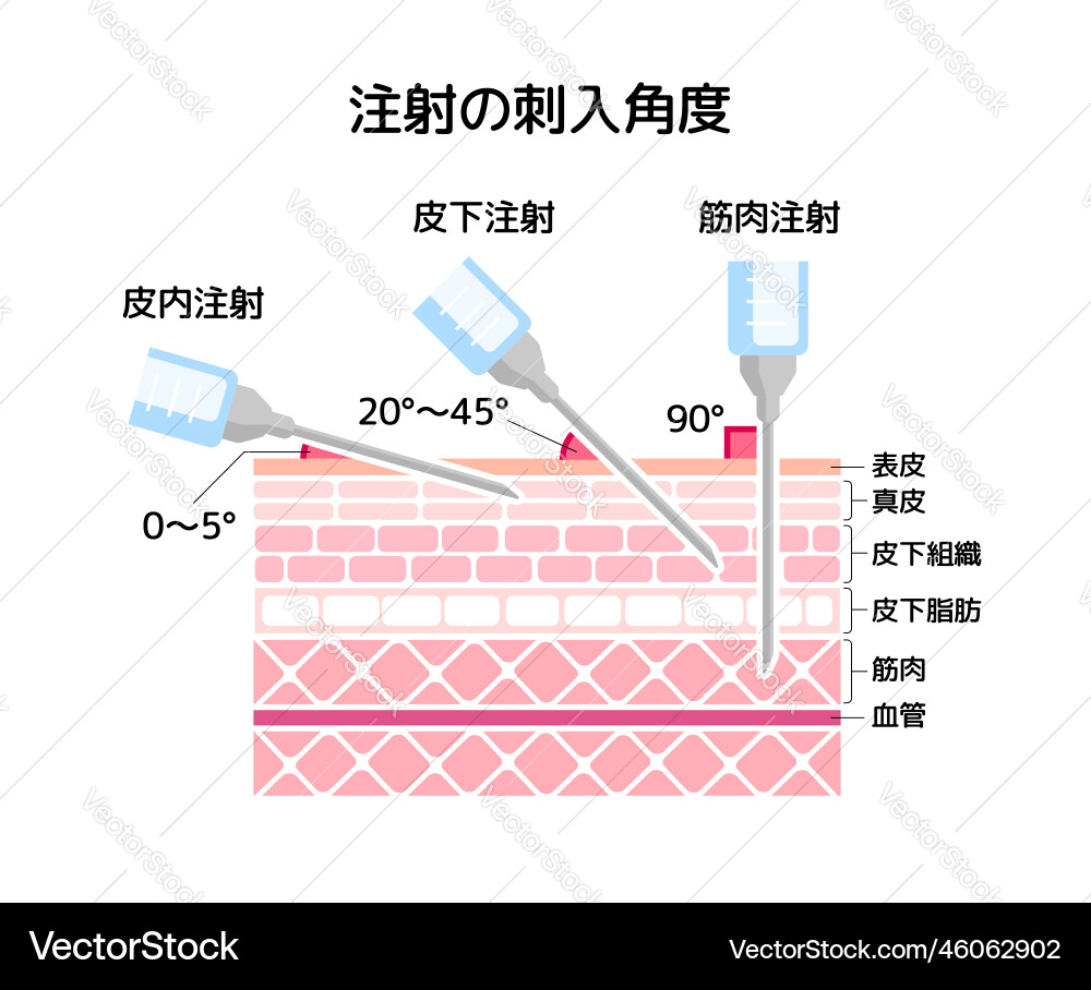 Angles for inserting injections Angles for inserting injections Vector Image