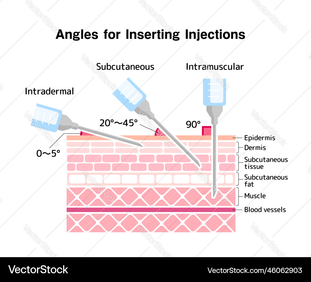 Angles for inserting injections Vector Image
