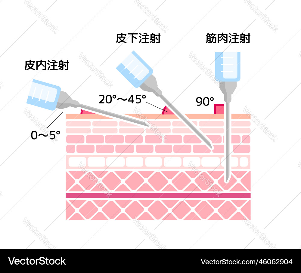 Angles for inserting injections Vector Image
