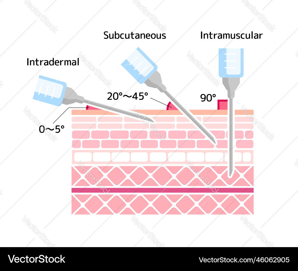 Angles for inserting injections Angles for inserting injections vector image