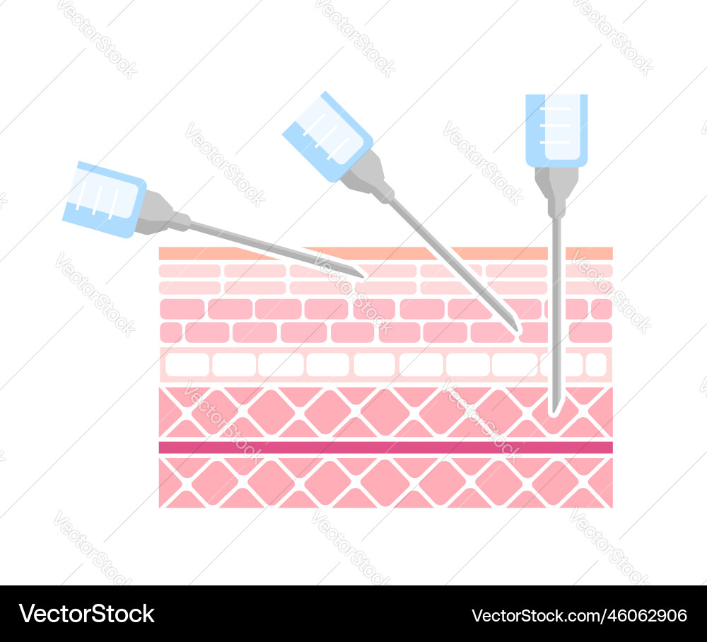 Angles for inserting injections Angles for inserting injections Vector Image