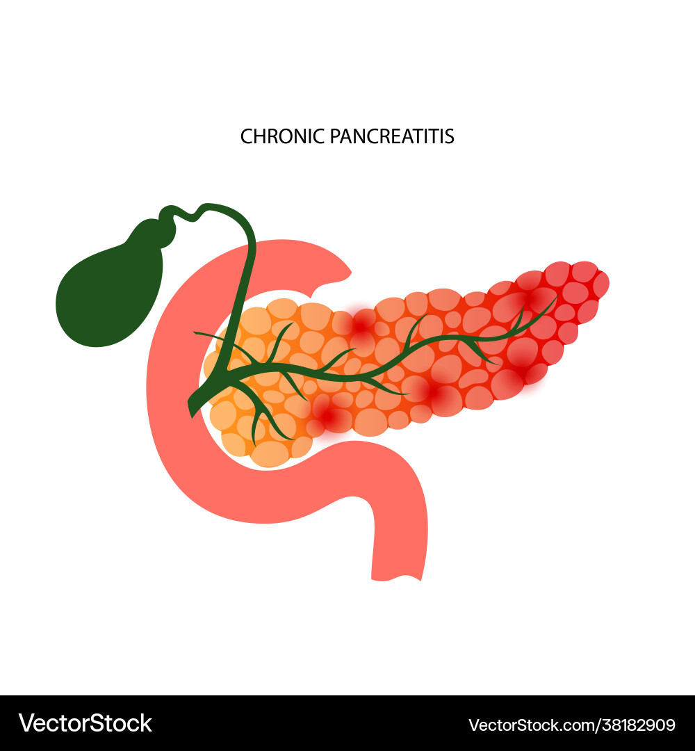 Chronic Pancreatitis Concept Royalty Free Vector Image
