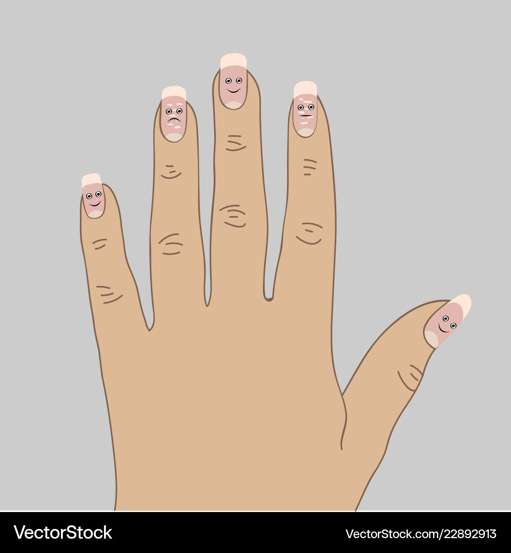 White spots on the nails cartoon White spots on the nails cartoon vector image