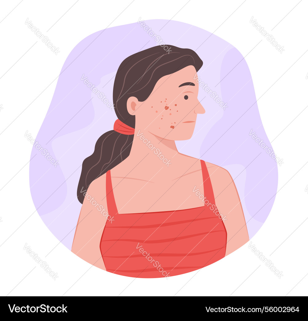 Frau mit Akne auf Gesicht für dermatologische Konzept Frau mit Akne auf Gesicht für dermatologische Konzept vektorbild