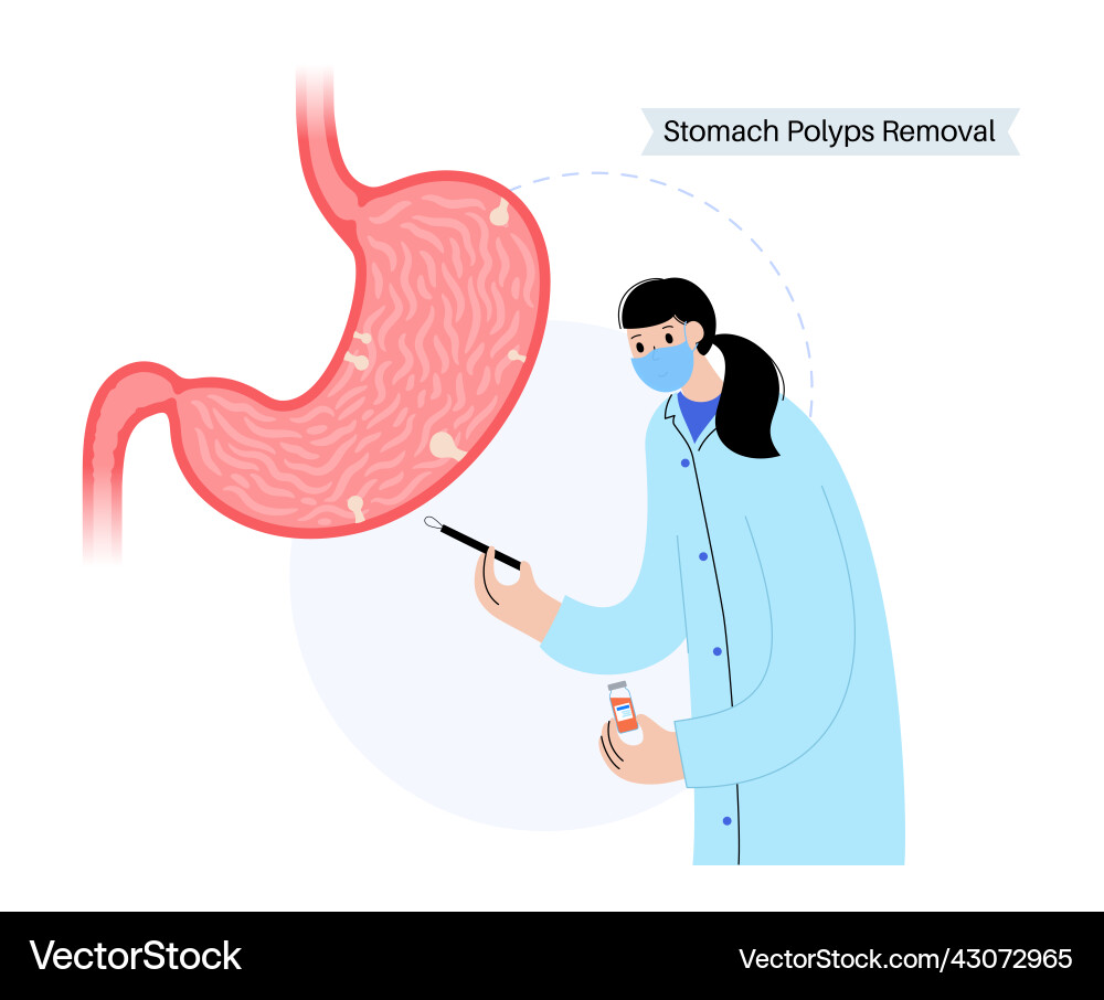 Stomach polyp Entfernung Vektorbild