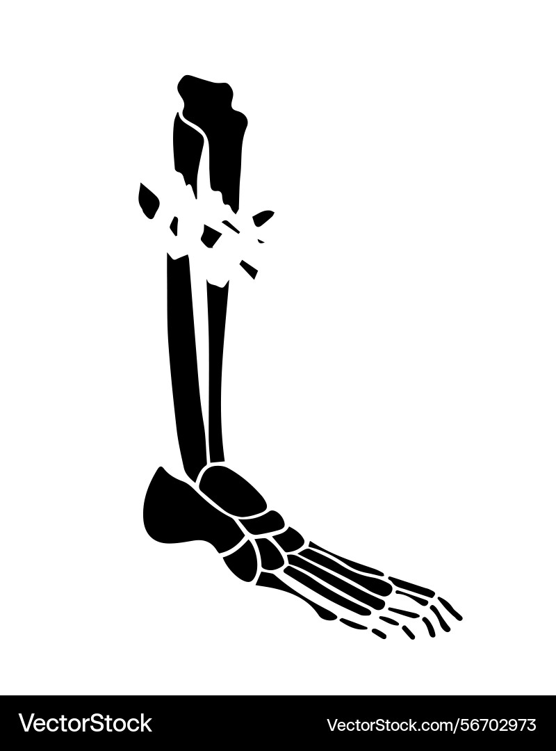 An open fracture of the tibia x-ray An open fracture of the tibia x-ray vector image