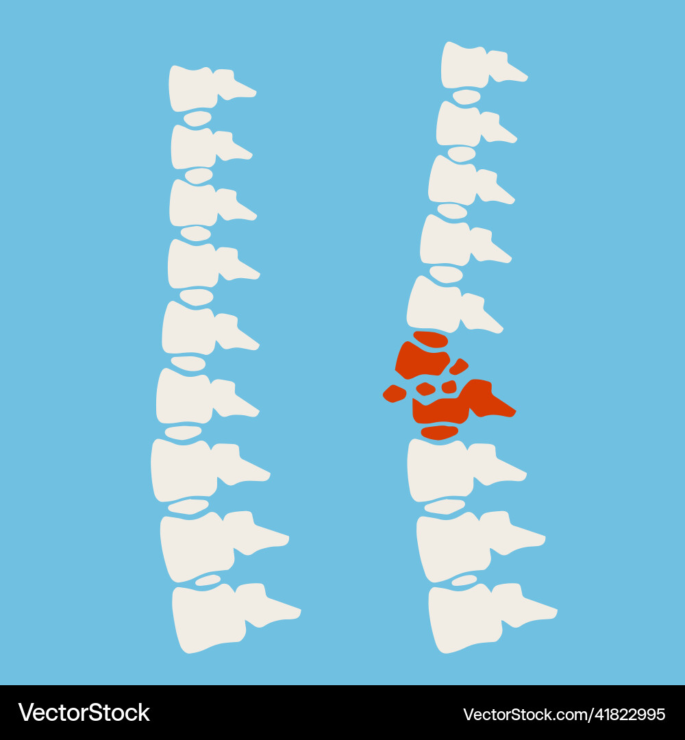 Problems with spine posture issues Problems with spine posture issues vector image