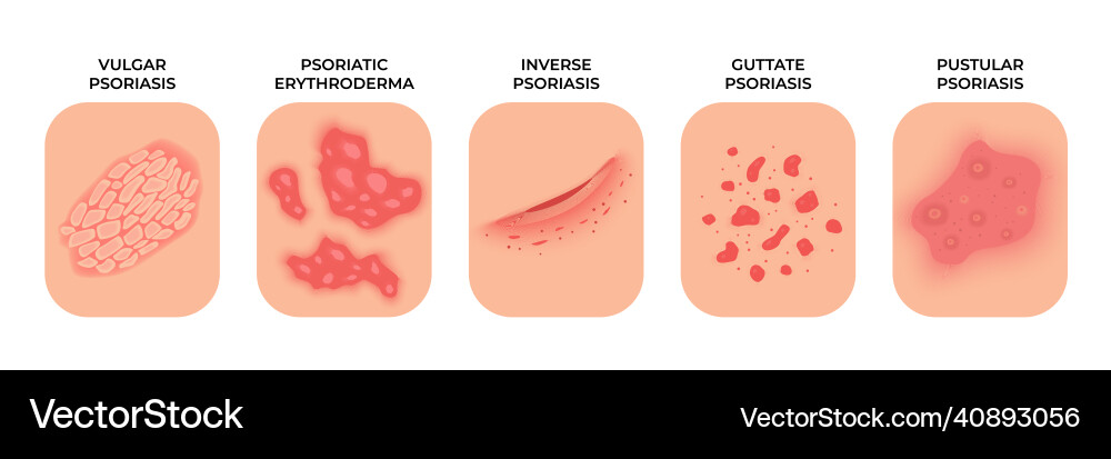 Psoriasis allergic eczema types rashes treatment vector image