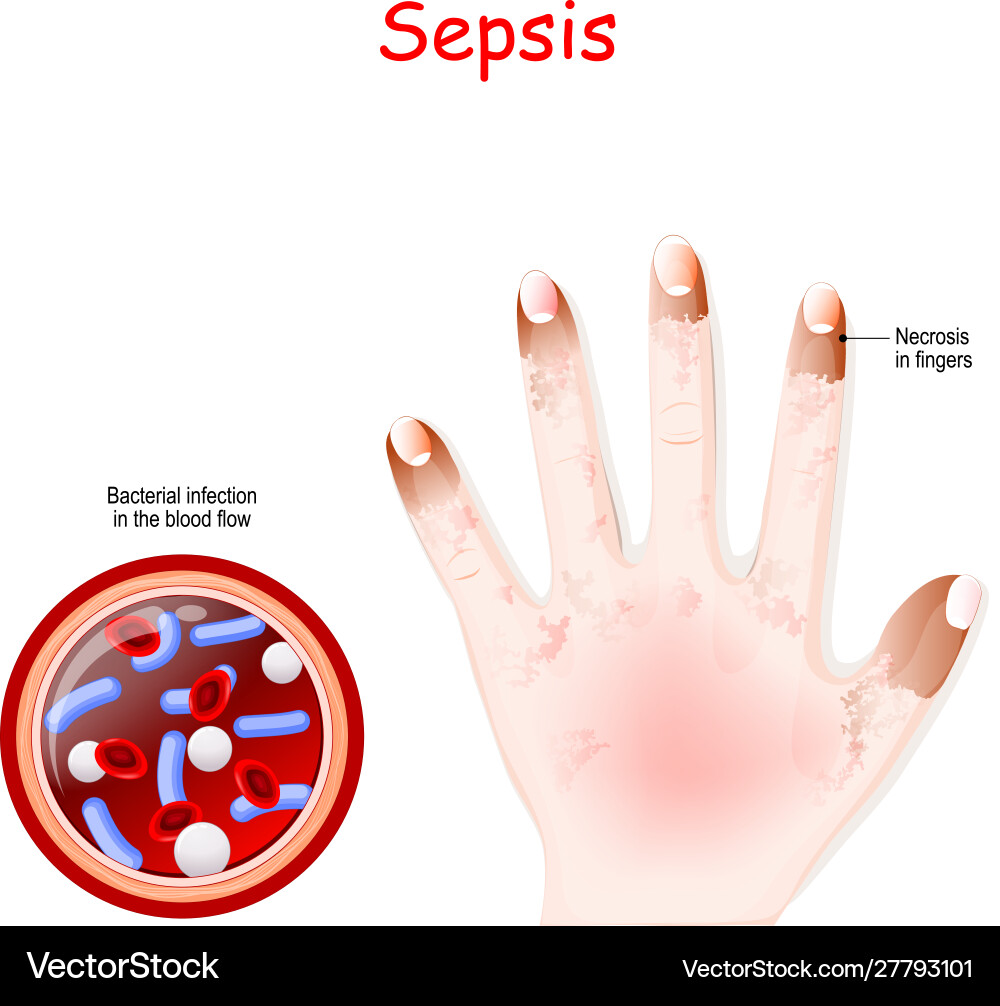 Sepsis Nahaufnahmequerschnitt Blutgefäß Sepsis Nahaufnahmequerschnitt Blutgefäß vektorbild