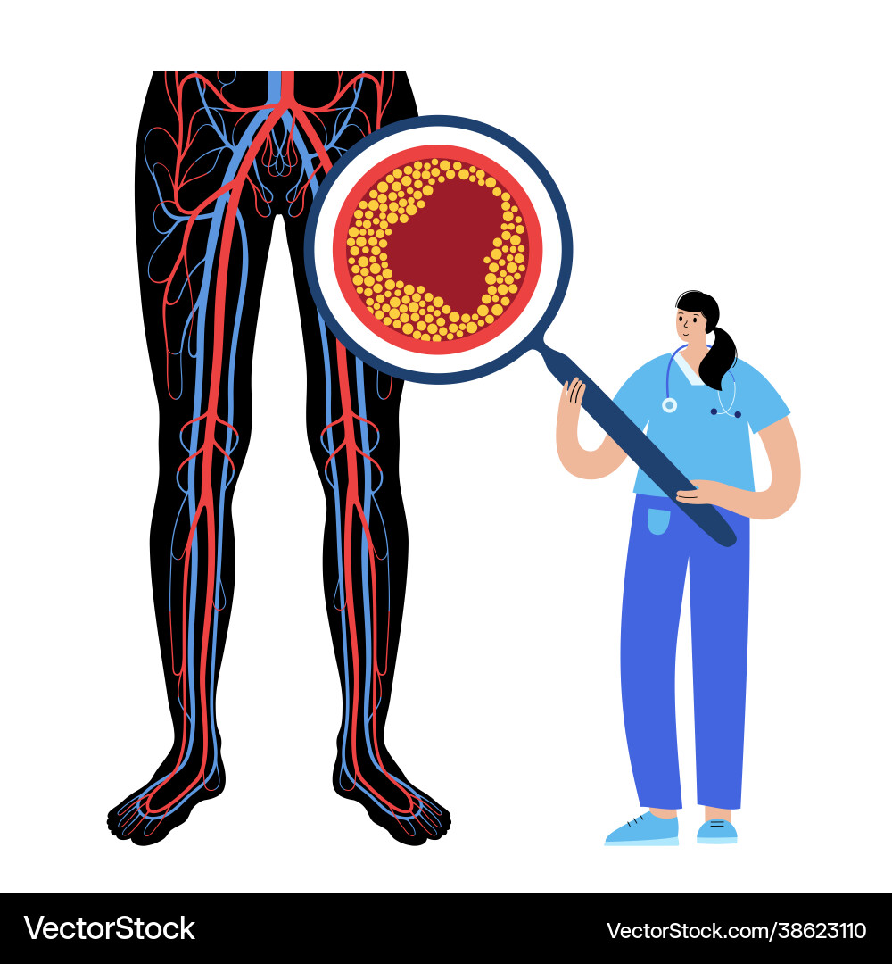 Peripheral artery disease vector image