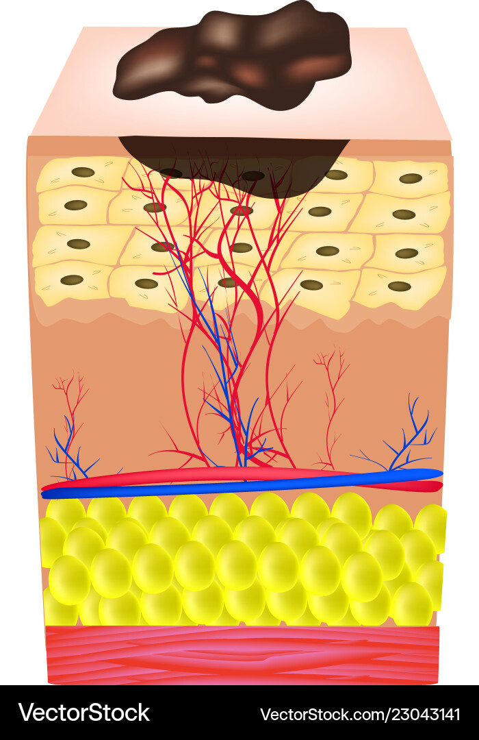Struktur der Nevus Mole Struktur der Nevus Mole vektorbild