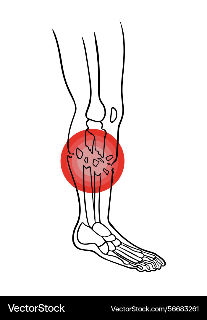 An open fracture of the tibia x-ray An open fracture of the tibia x-ray vector image
