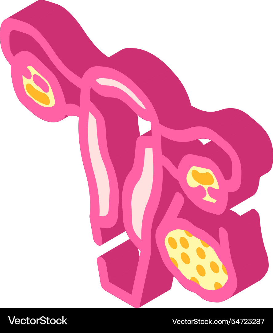 Polycystische Ovary Syndrom Frau Krankheit isometrische Polycystische Ovary Syndrom Frau Krankheit isometrische vektorbild