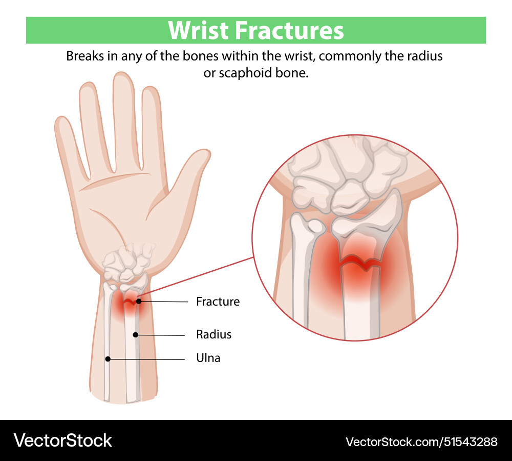 Diagram showing wrist fractures and bones Vector Image