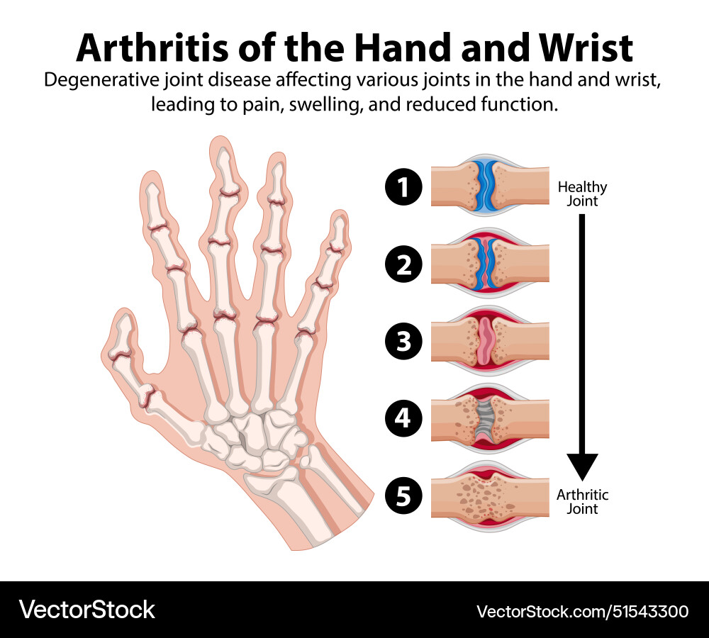 Degenerative joint disease affecting hand Vector Image