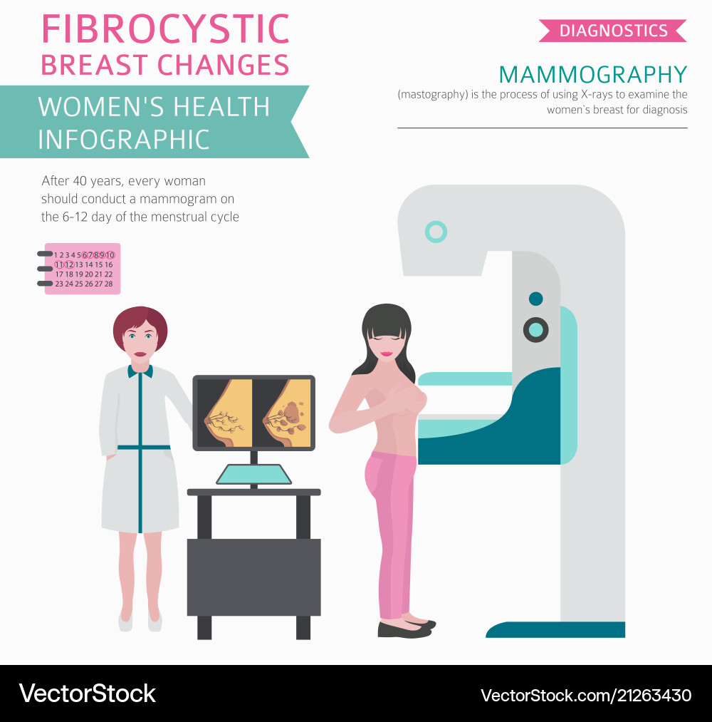Fibrocystische Brust ändert Krankheit medizinische Fibrocystische Brust ändert Krankheit medizinische vektorbild