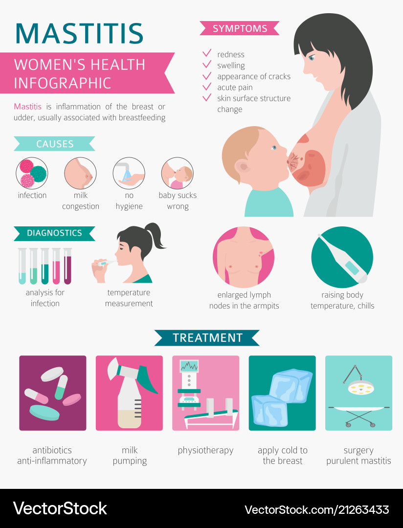 Mastitis stillen medizinische Infografik Mastitis stillen medizinische Infografik vektorbild