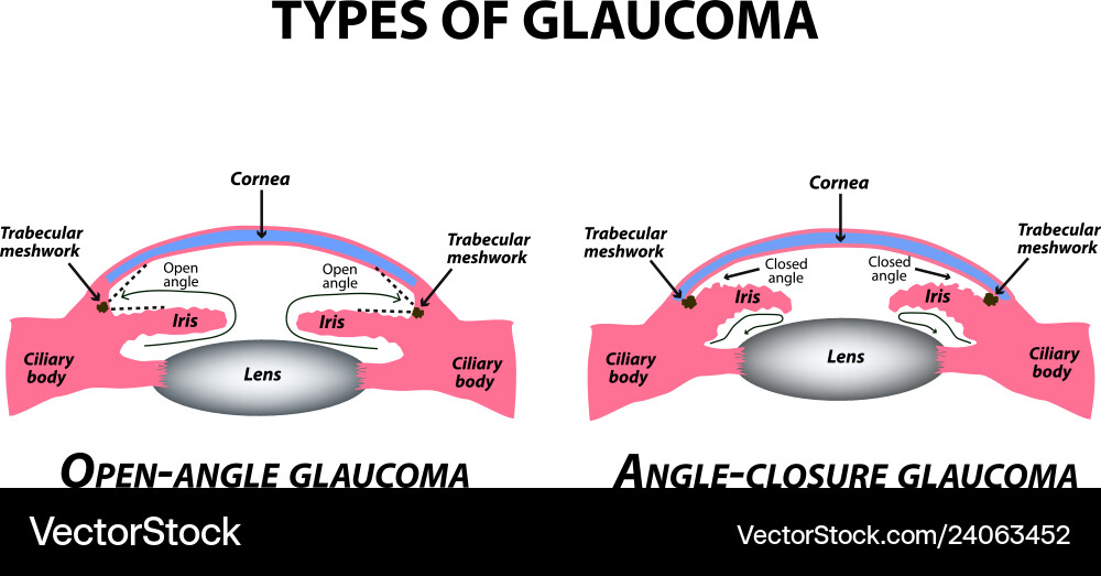 Glaucoma Types: Open & Angle Closure Vector Image