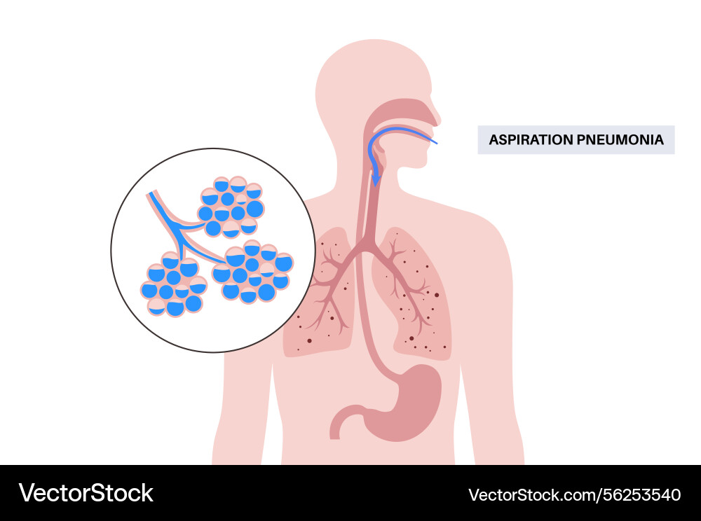 Aspiration pneumonia post Aspiration pneumonia post vektorbild