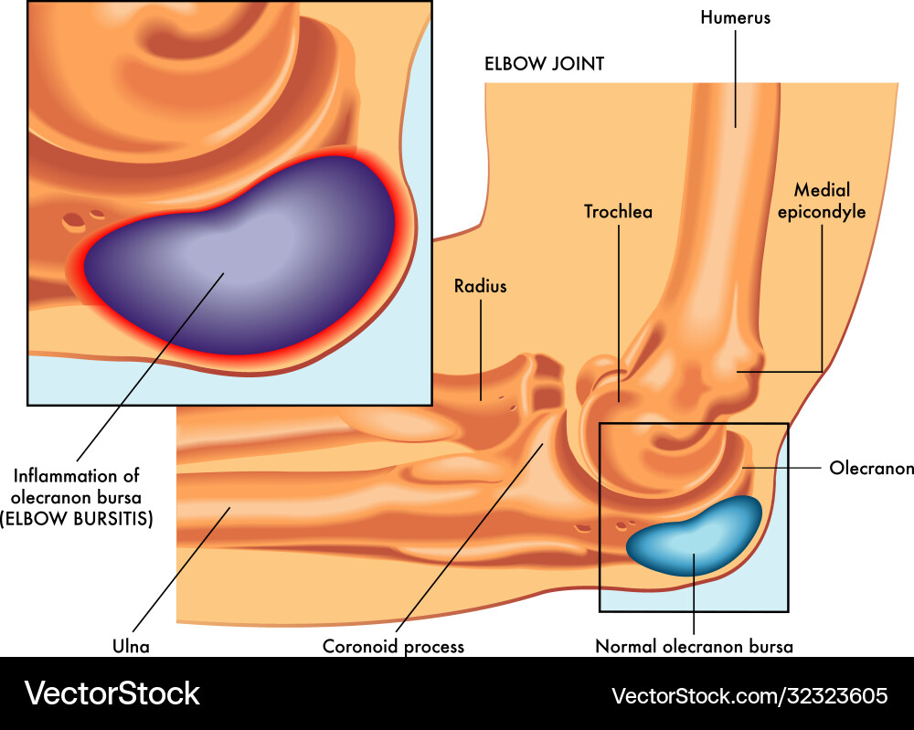 Elbow bursitis Elbow bursitis vector image