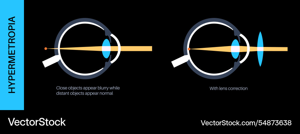 Farsightedness lens correction Royalty Free Vector Image