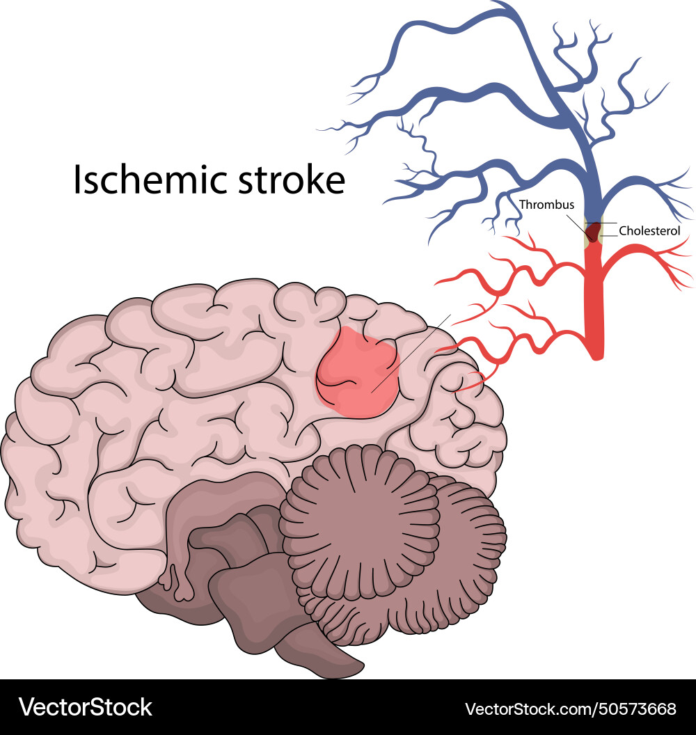 Ischemic stroke brain Royalty Free Vector Image