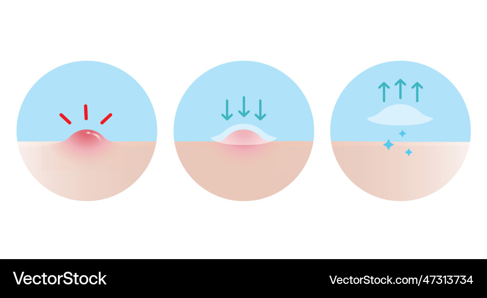 Acne Pimple Patch Usage Guide vector image