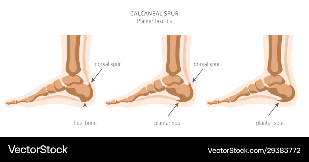 Calcaneal spur plantar fasciitis set medical Calcaneal spur plantar fasciitis set medical vector image