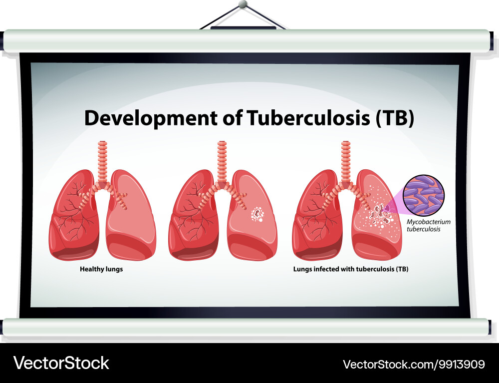 Chart showing development of tuberculosis vector image