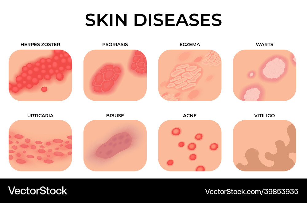 Skin disease different diseases epidermis Skin disease different diseases epidermis vector image