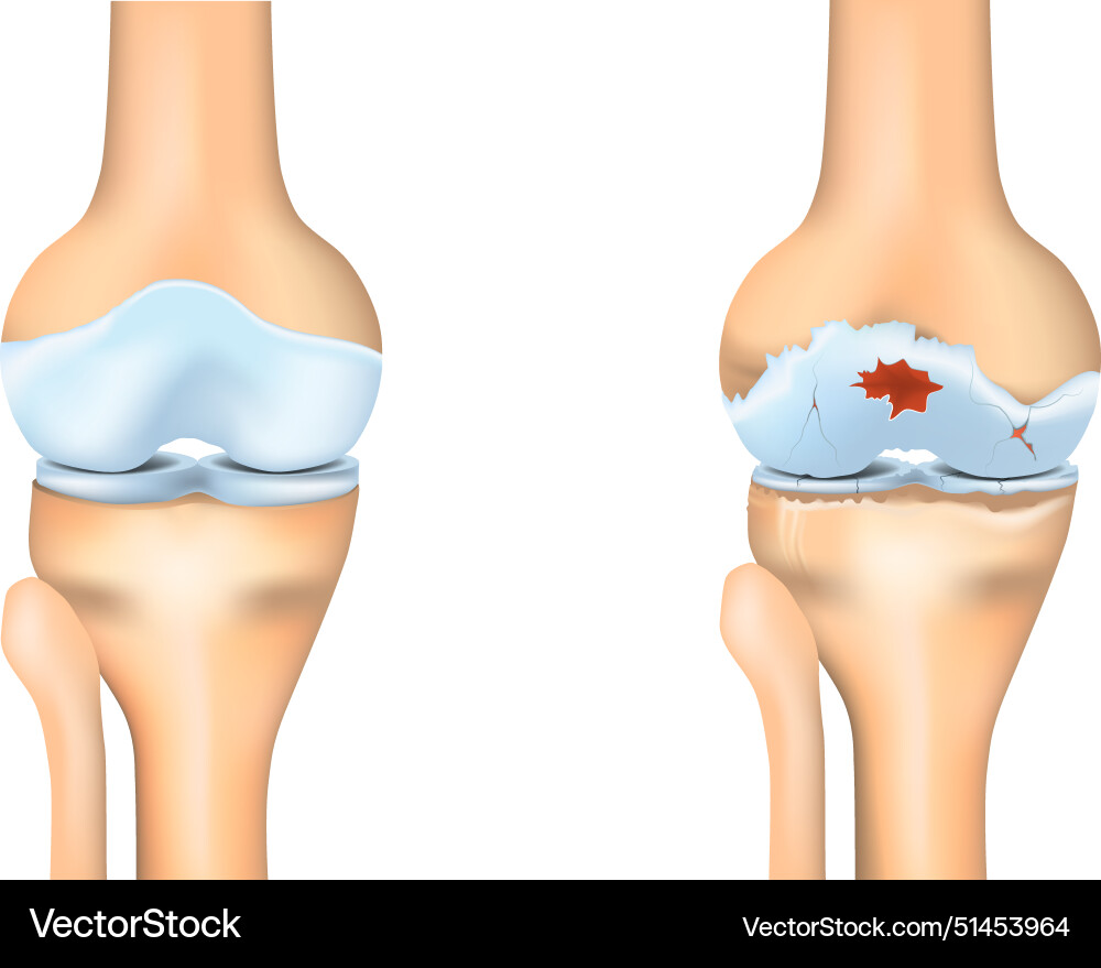 Knee osteoarthritis joint degeneration Knee osteoarthritis joint degeneration vector image